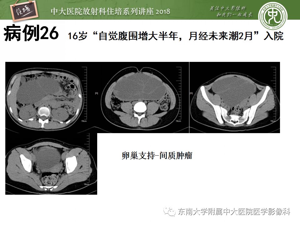 【PPT】卵巢占位诊断与鉴别
