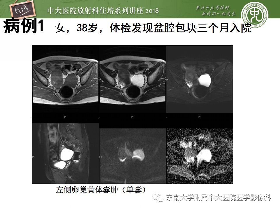 【PPT】卵巢占位诊断与鉴别