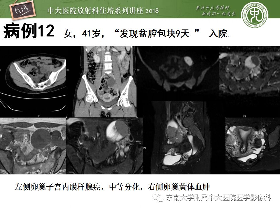 【PPT】卵巢占位诊断与鉴别