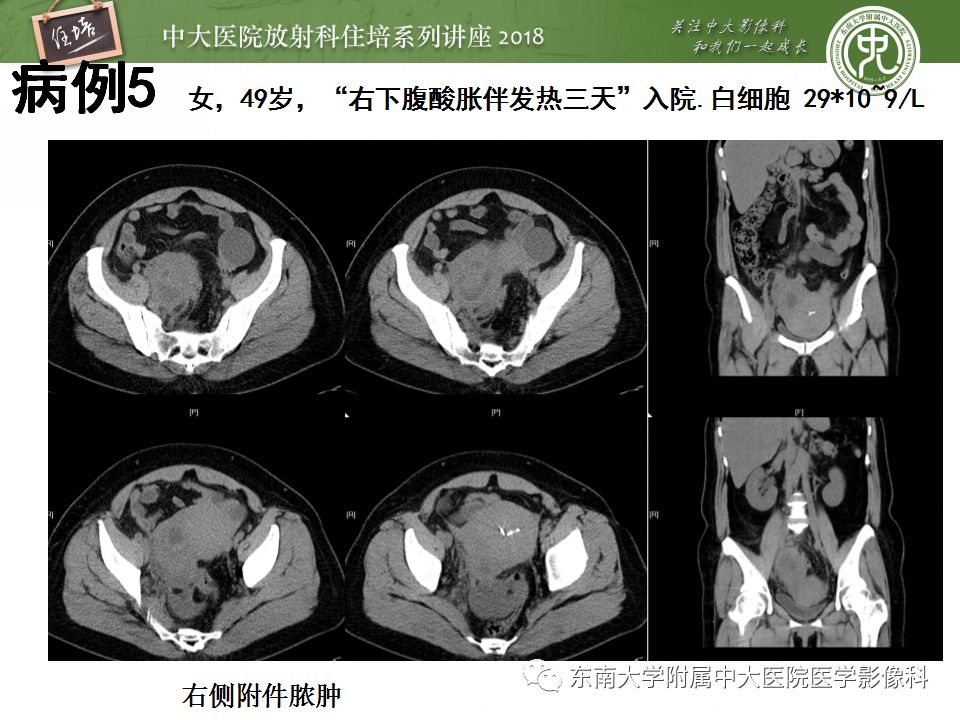 【PPT】卵巢占位诊断与鉴别