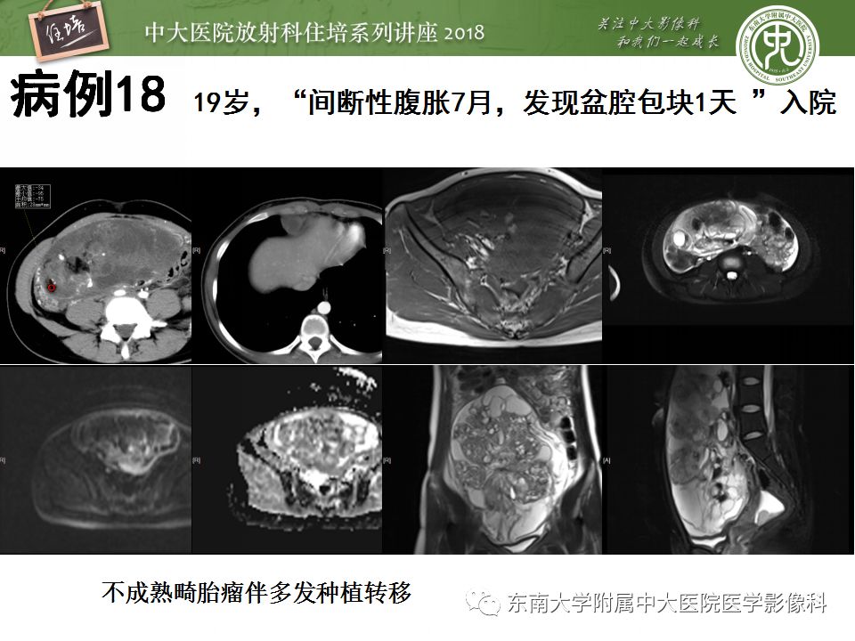 【PPT】卵巢占位诊断与鉴别