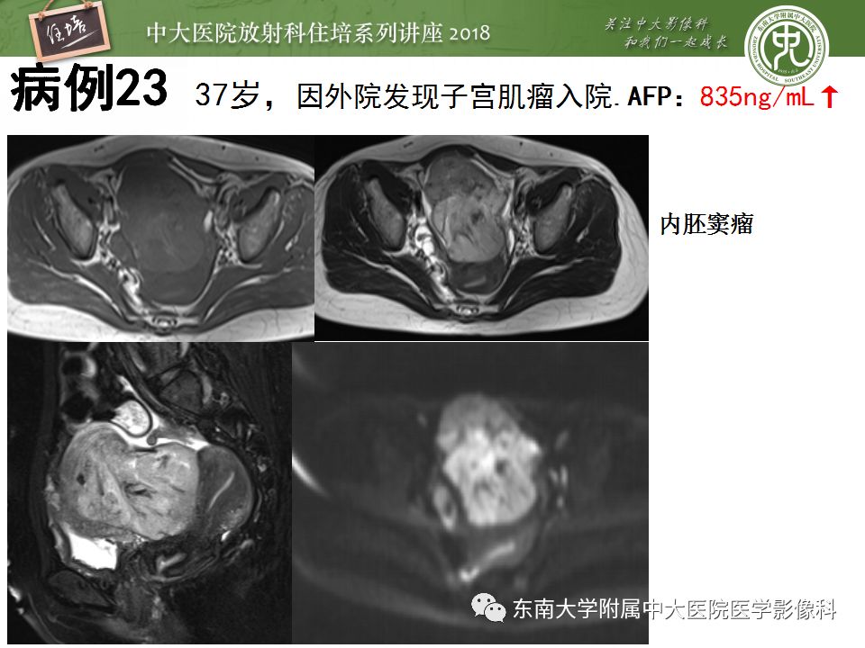 【PPT】卵巢占位诊断与鉴别