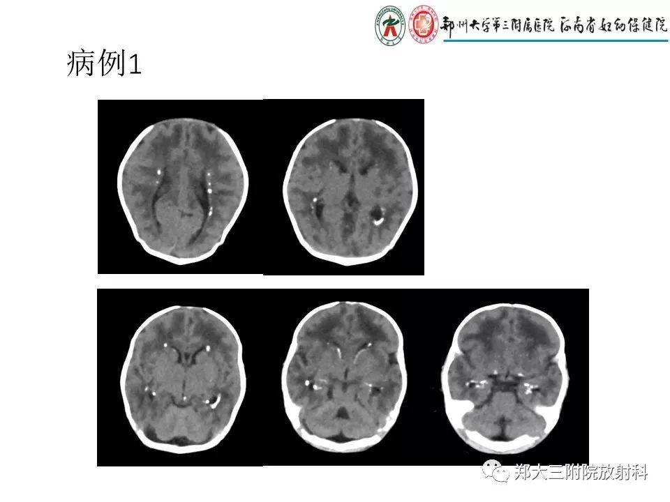 【PPT】颅内钙化性疾病的鉴别诊断
