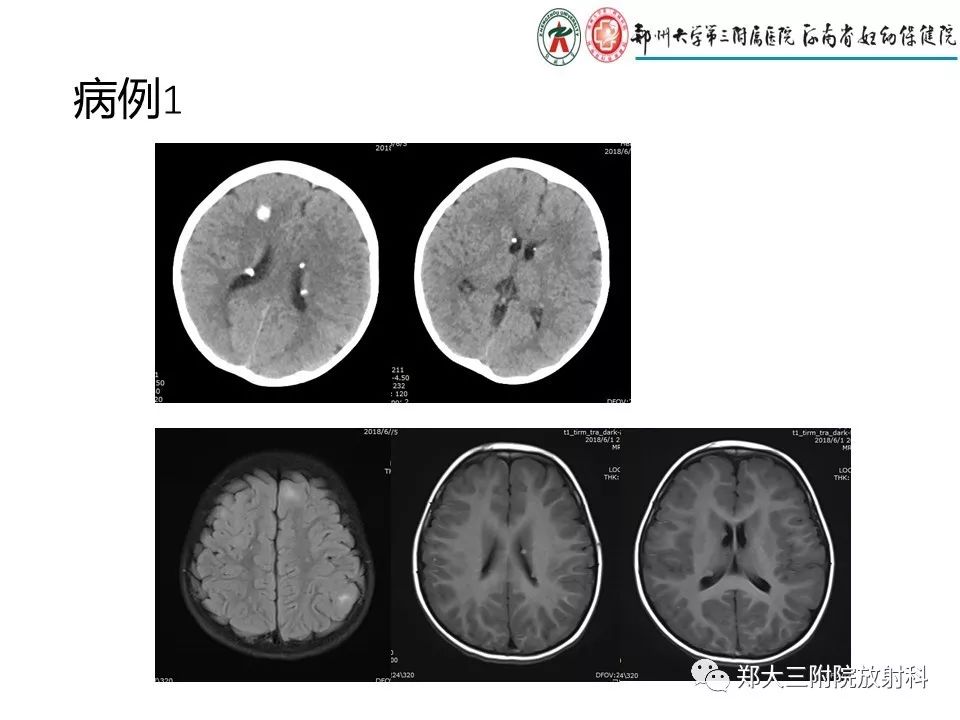 【PPT】颅内钙化性疾病的鉴别诊断