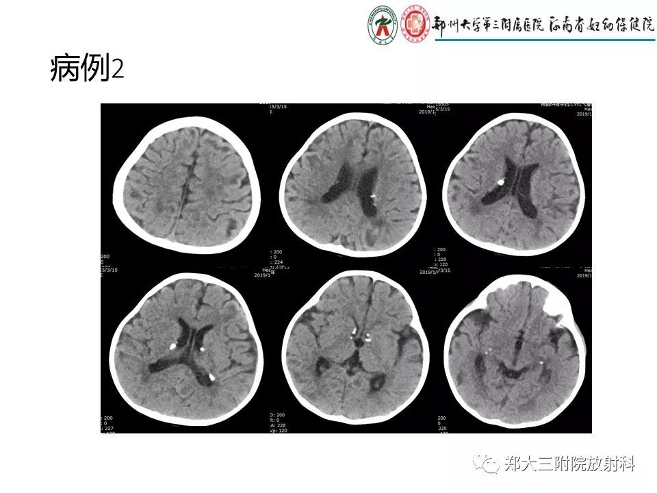 【PPT】颅内钙化性疾病的鉴别诊断