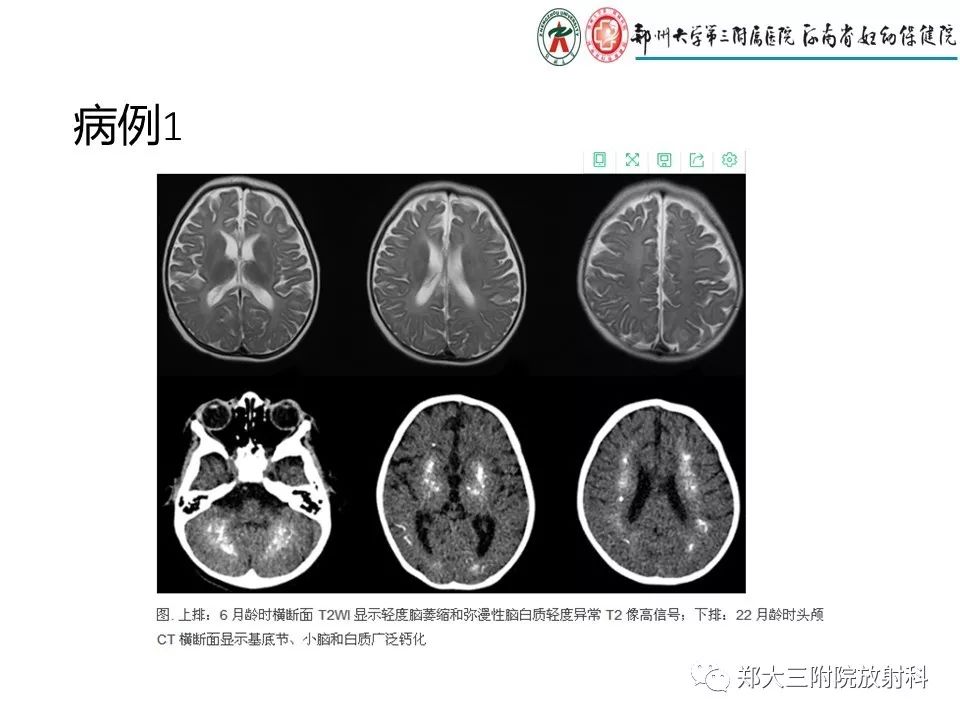 【PPT】颅内钙化性疾病的鉴别诊断