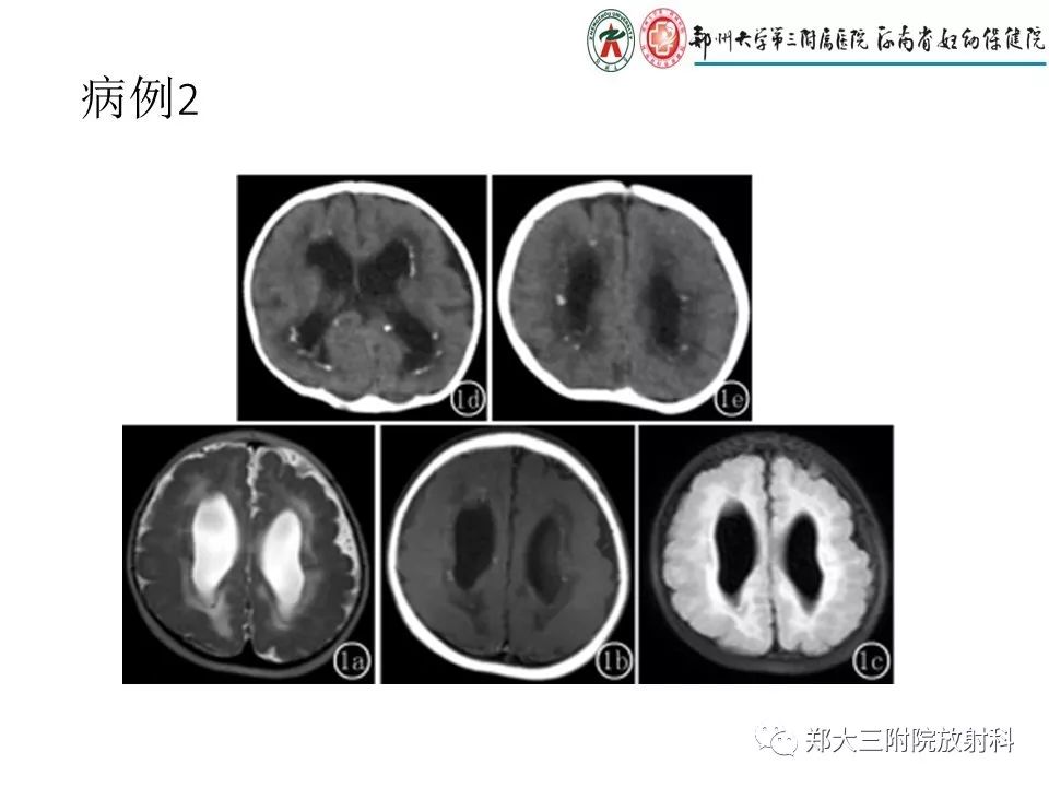 【PPT】颅内钙化性疾病的鉴别诊断