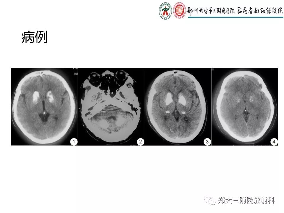 【PPT】颅内钙化性疾病的鉴别诊断