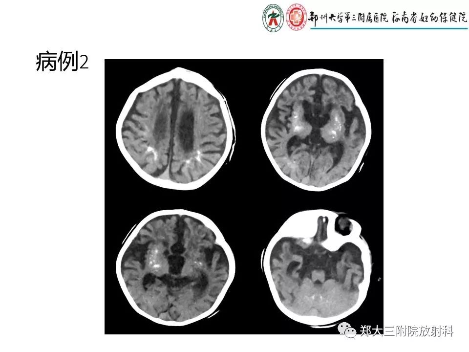【PPT】颅内钙化性疾病的鉴别诊断