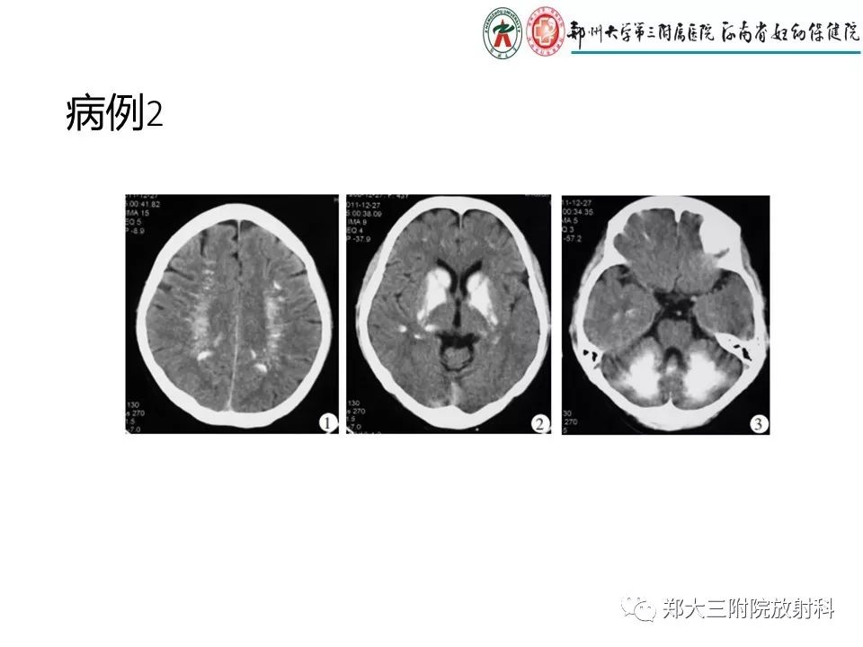【PPT】颅内钙化性疾病的鉴别诊断