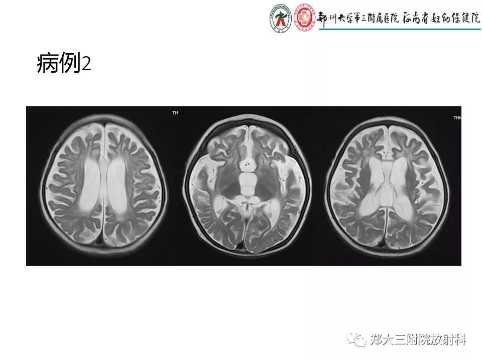 【PPT】颅内钙化性疾病的鉴别诊断
