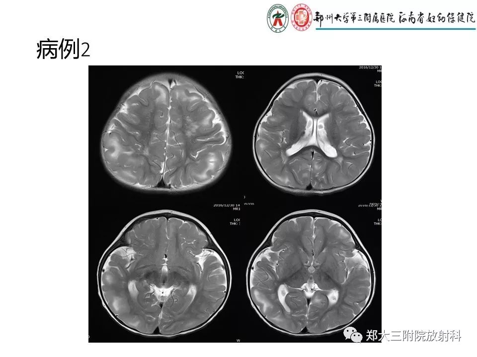 【PPT】颅内钙化性疾病的鉴别诊断