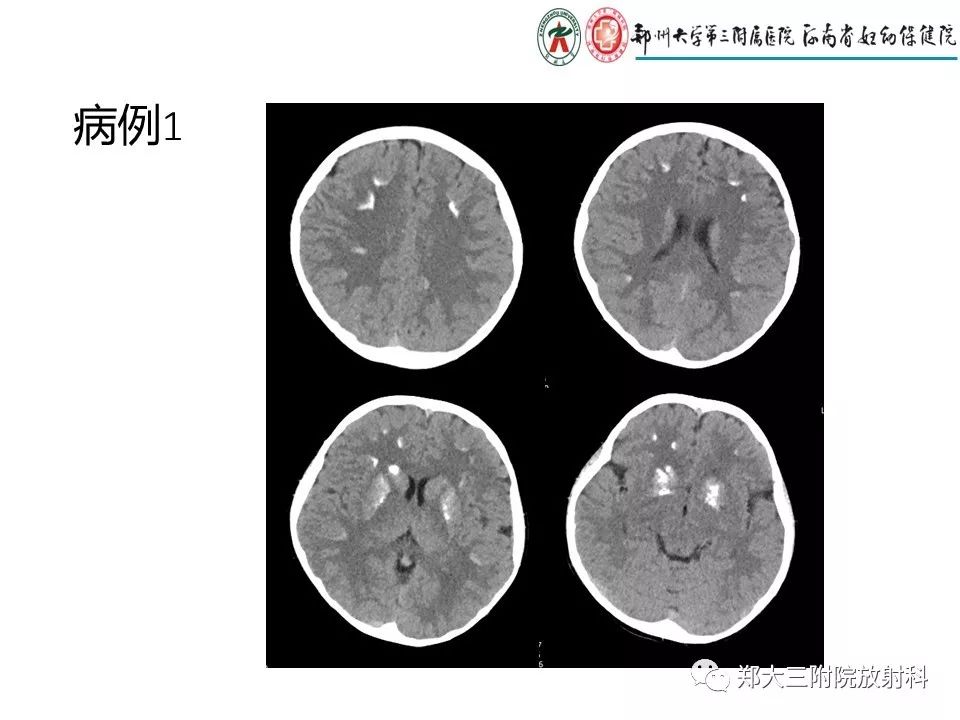 【PPT】颅内钙化性疾病的鉴别诊断