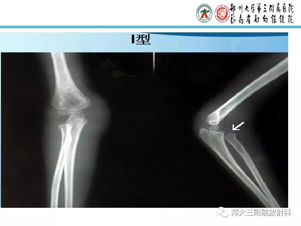 【PPT】儿童肘关节骨折的X线表现