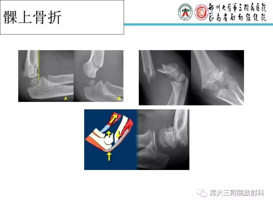 【PPT】儿童肘关节骨折的X线表现