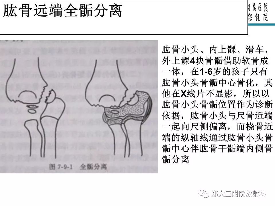 【PPT】儿童肘关节骨折的X线表现