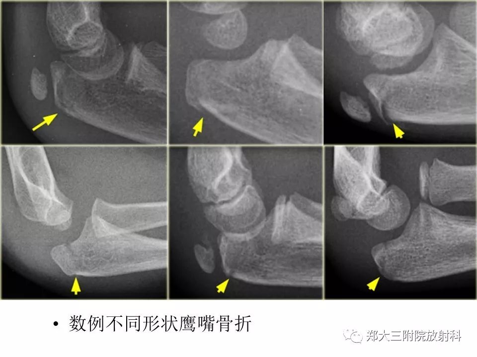 【PPT】儿童肘关节骨折的X线表现