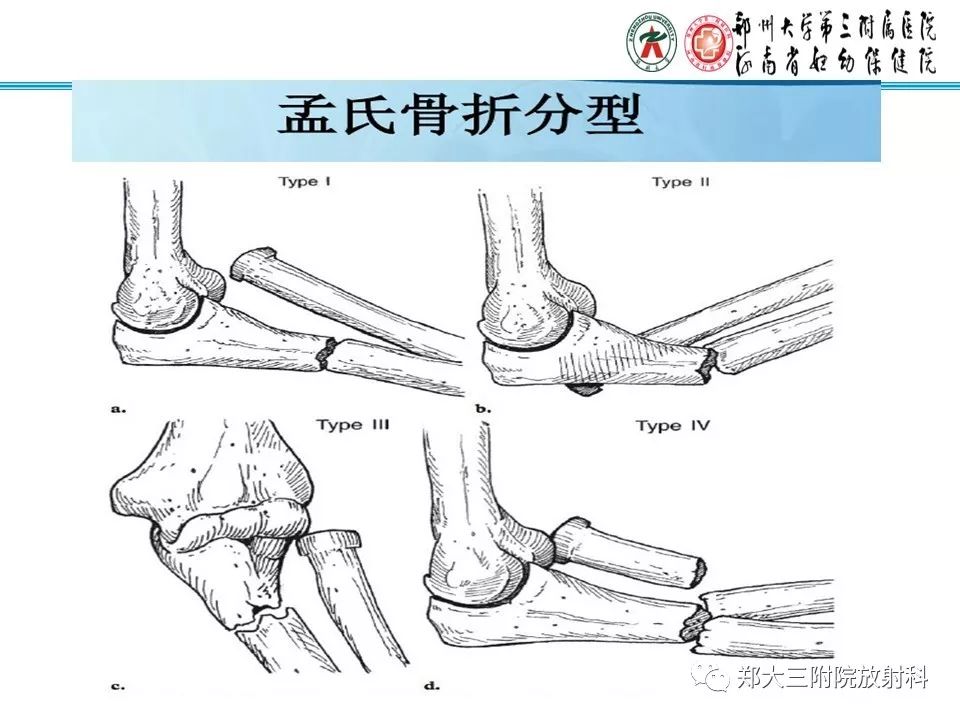 【PPT】儿童肘关节骨折的X线表现