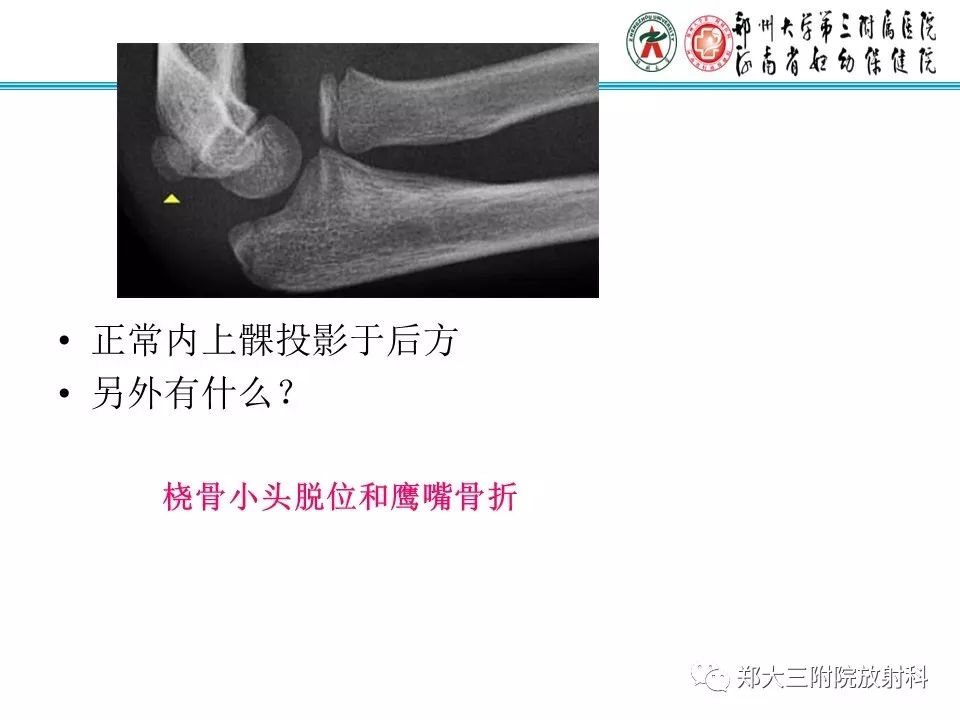 【PPT】儿童肘关节骨折的X线表现