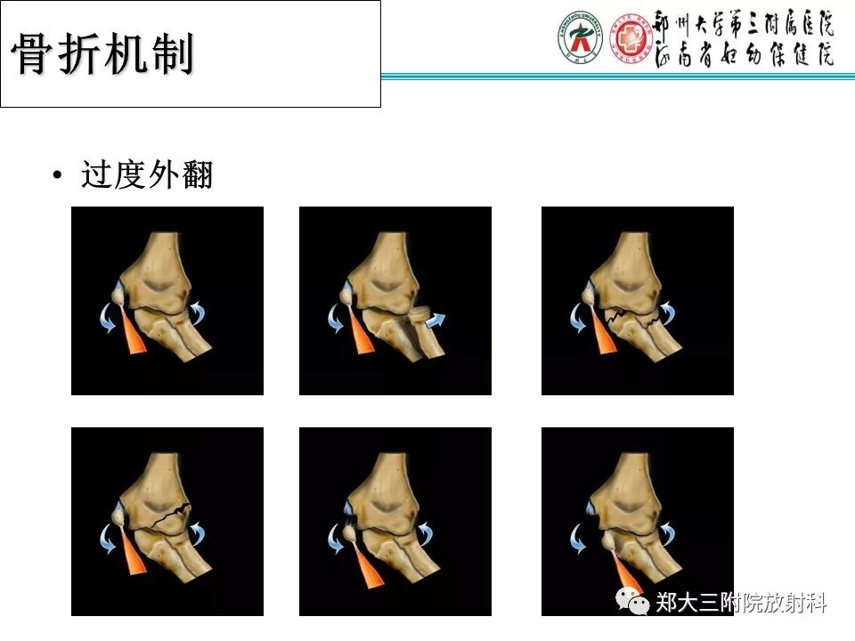 【PPT】儿童肘关节骨折的X线表现