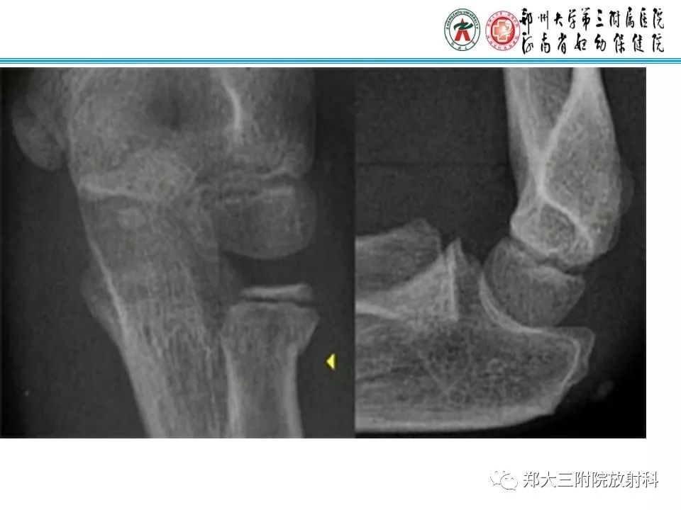 【PPT】儿童肘关节骨折的X线表现