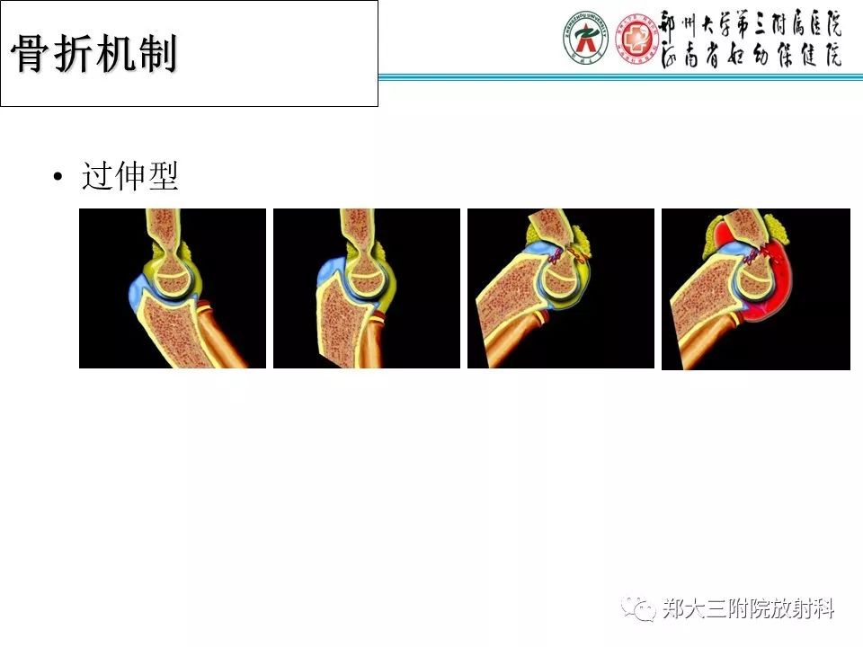 【PPT】儿童肘关节骨折的X线表现