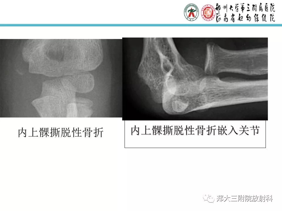 【PPT】儿童肘关节骨折的X线表现