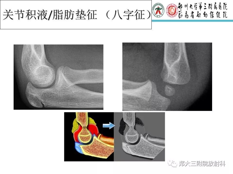 【PPT】儿童肘关节骨折的X线表现
