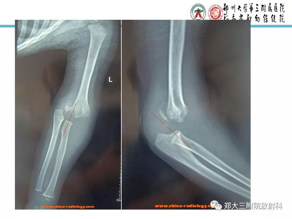 【PPT】儿童肘关节骨折的X线表现