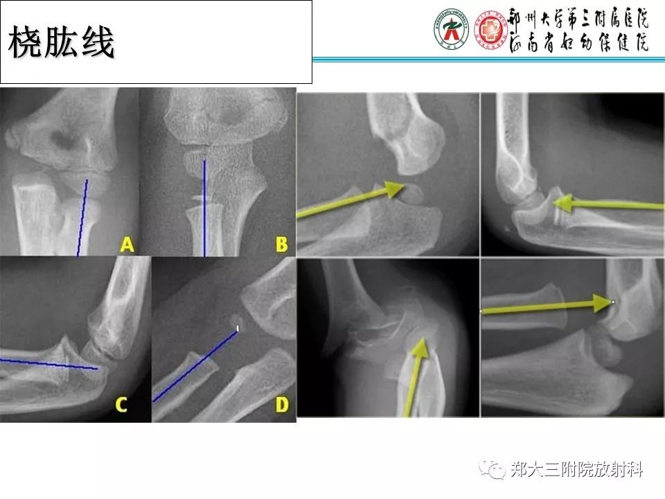 【PPT】儿童肘关节骨折的X线表现