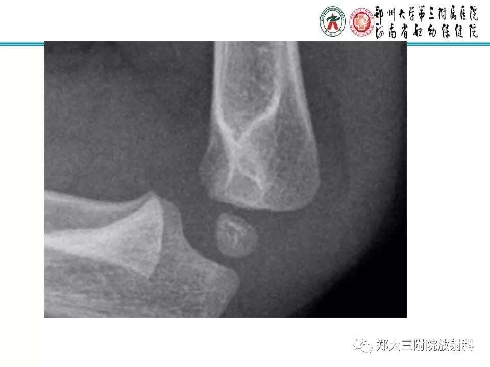 【PPT】儿童肘关节骨折的X线表现