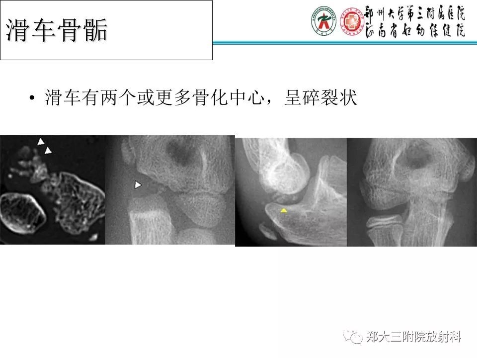 【PPT】儿童肘关节骨折的X线表现