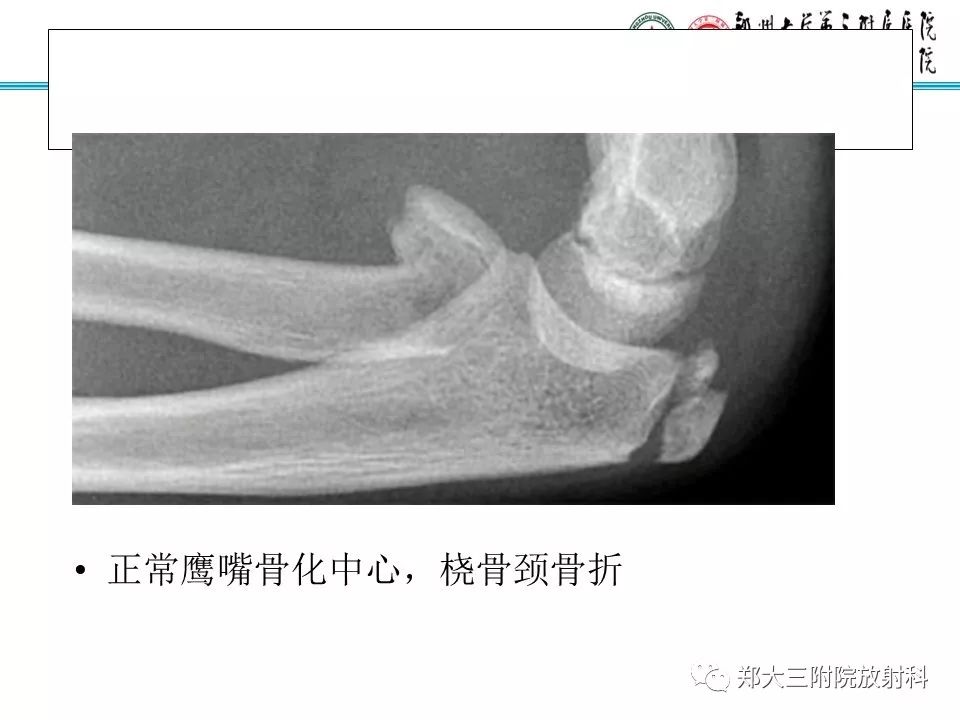【PPT】儿童肘关节骨折的X线表现