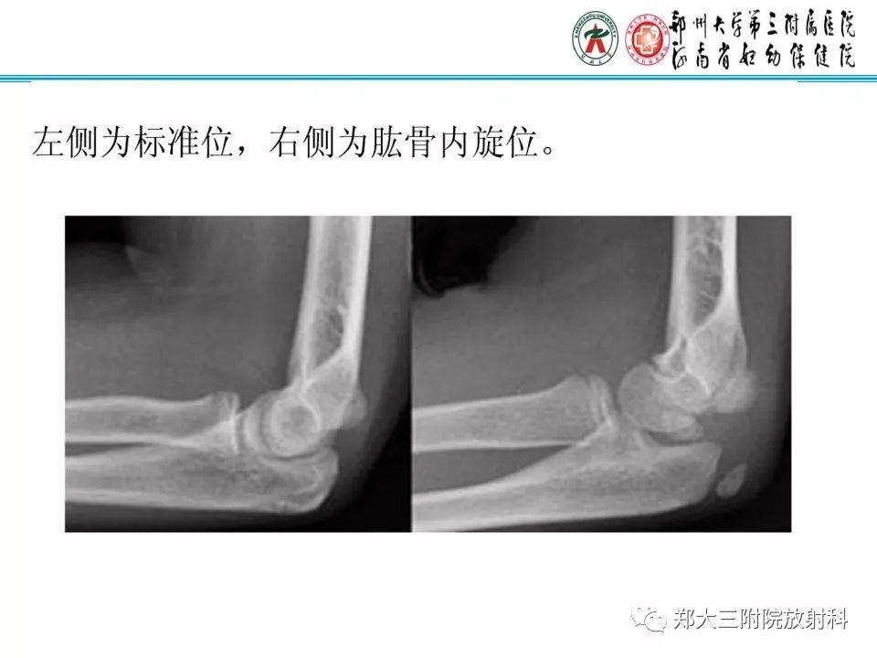 【PPT】儿童肘关节骨折的X线表现