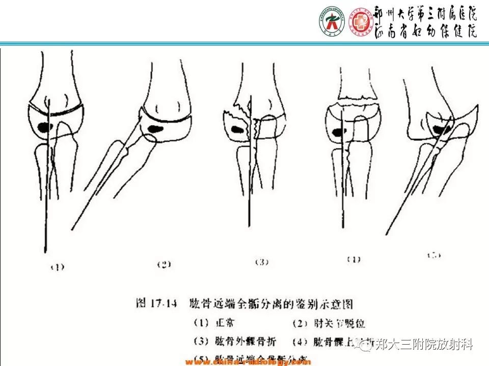 【PPT】儿童肘关节骨折的X线表现