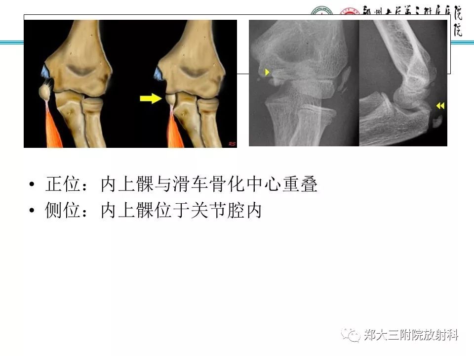 【PPT】儿童肘关节骨折的X线表现