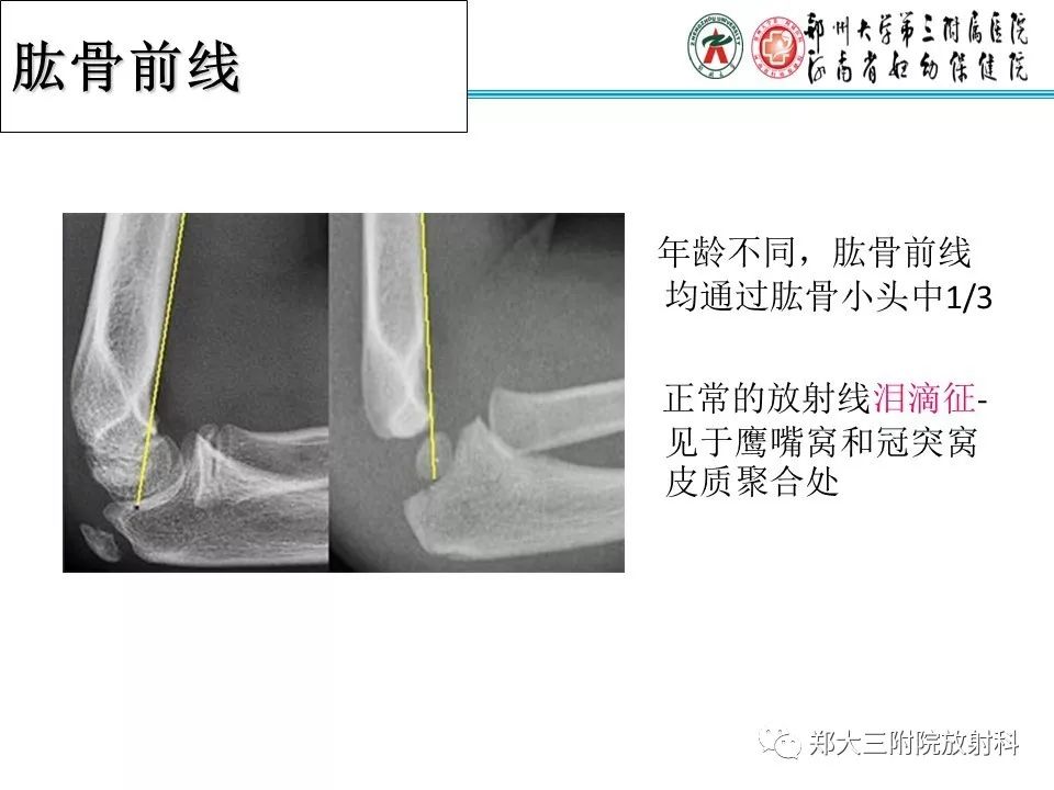 【PPT】儿童肘关节骨折的X线表现