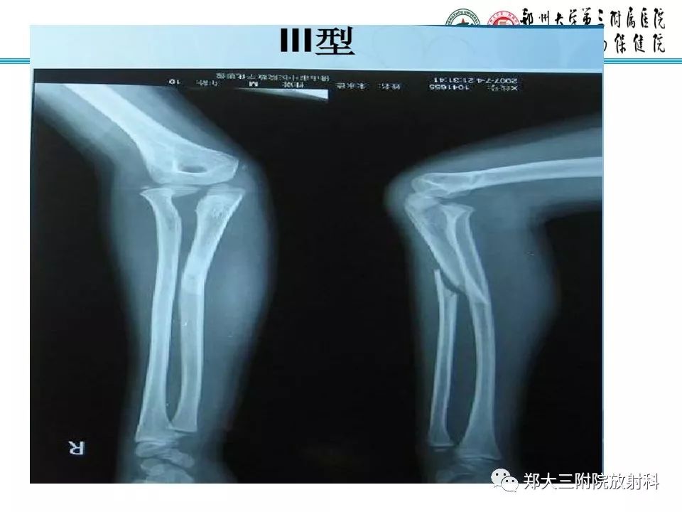 【PPT】儿童肘关节骨折的X线表现