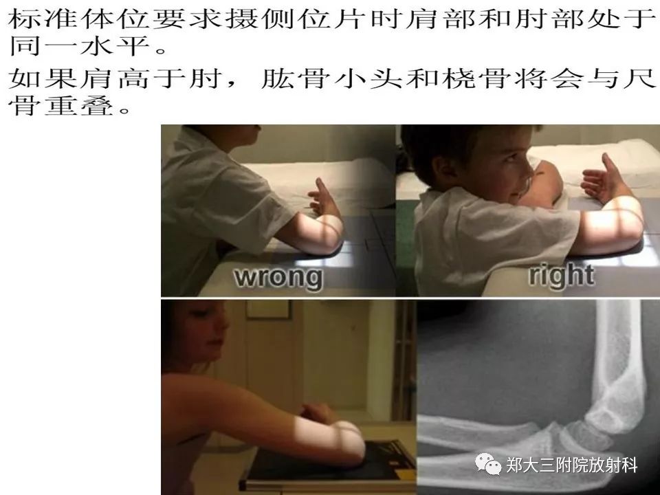【PPT】儿童肘关节骨折的X线表现