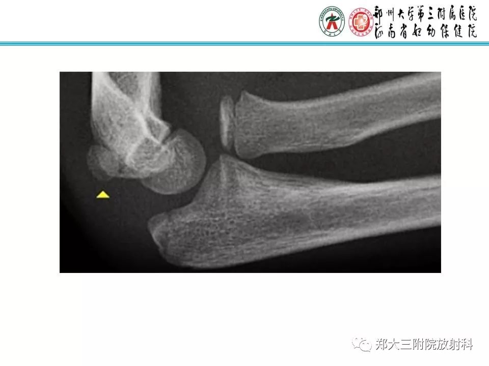 【PPT】儿童肘关节骨折的X线表现