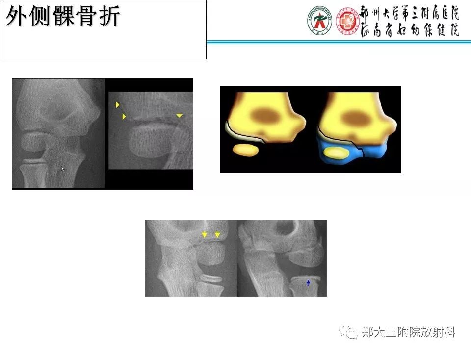 【PPT】儿童肘关节骨折的X线表现