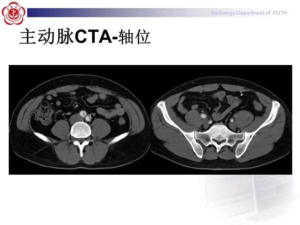 【PPT】主动脉夹层的影像