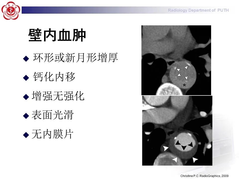 【PPT】主动脉夹层的影像