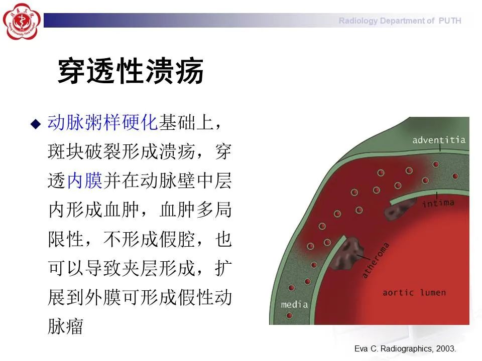【PPT】主动脉夹层的影像