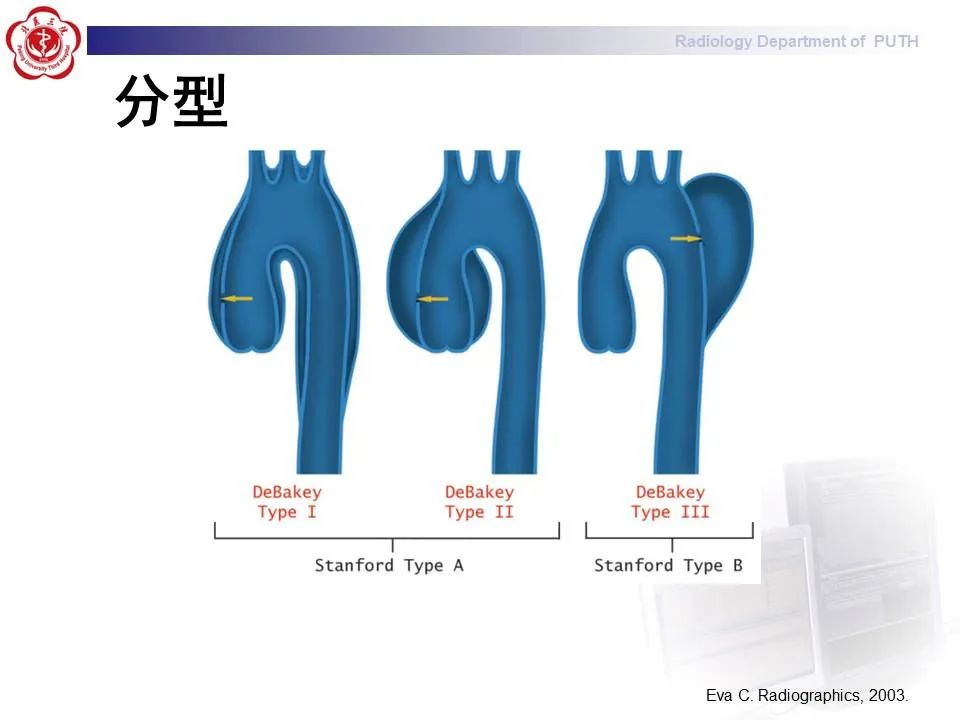 【PPT】主动脉夹层的影像