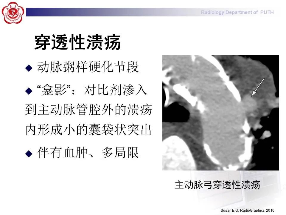【PPT】主动脉夹层的影像