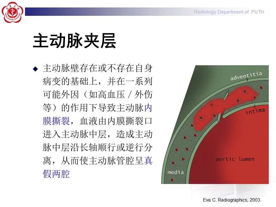 【PPT】主动脉夹层的影像