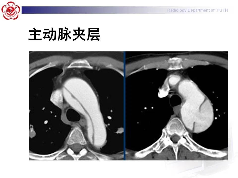 【PPT】主动脉夹层的影像