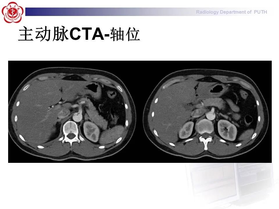 【PPT】主动脉夹层的影像