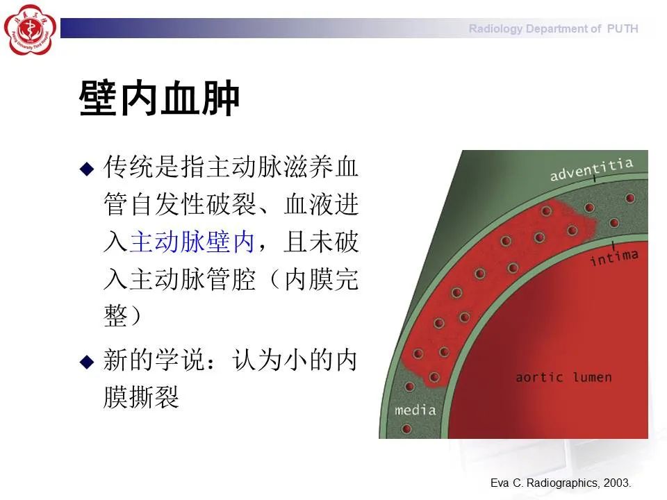 【PPT】主动脉夹层的影像